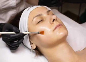 Chemical peel Glo Medical Aesthetic