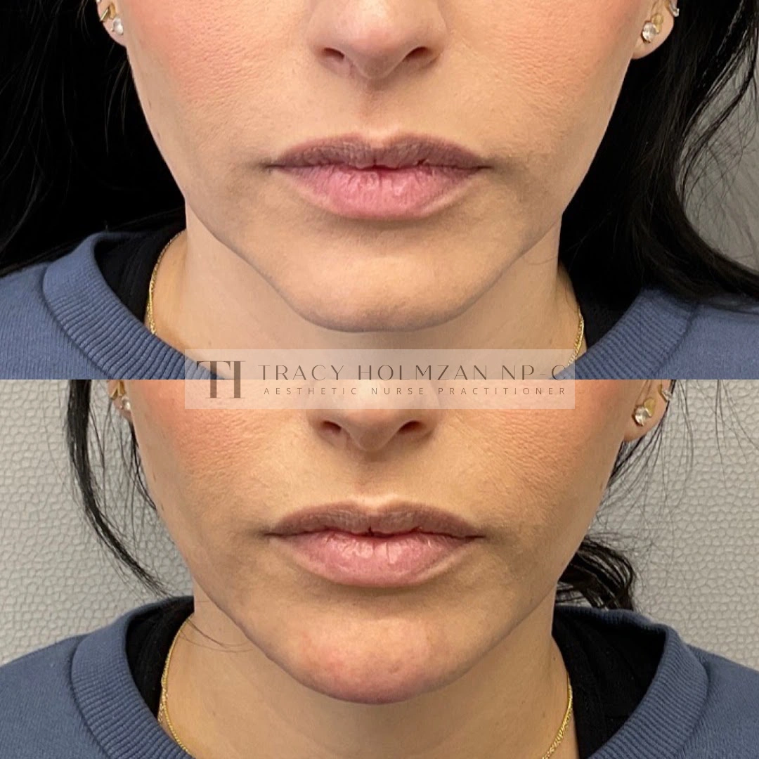 Ritual's Chin Filler Treatment Before & After Result