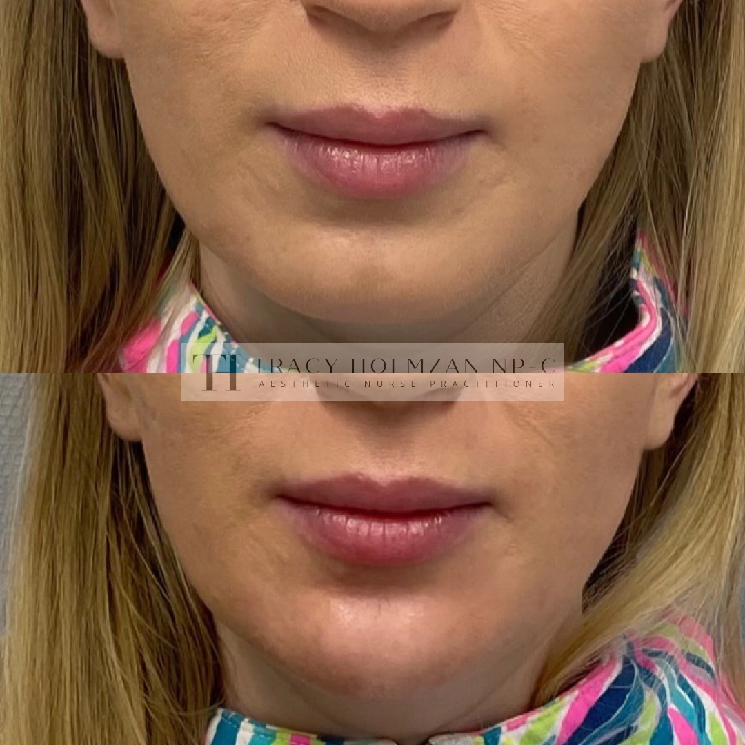 Ritual's Chin Filler Treatment Before & After Result