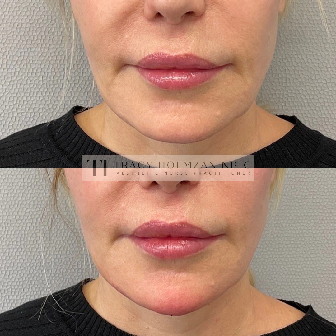 Ritual's Chin Filler Treatment Before & After Result