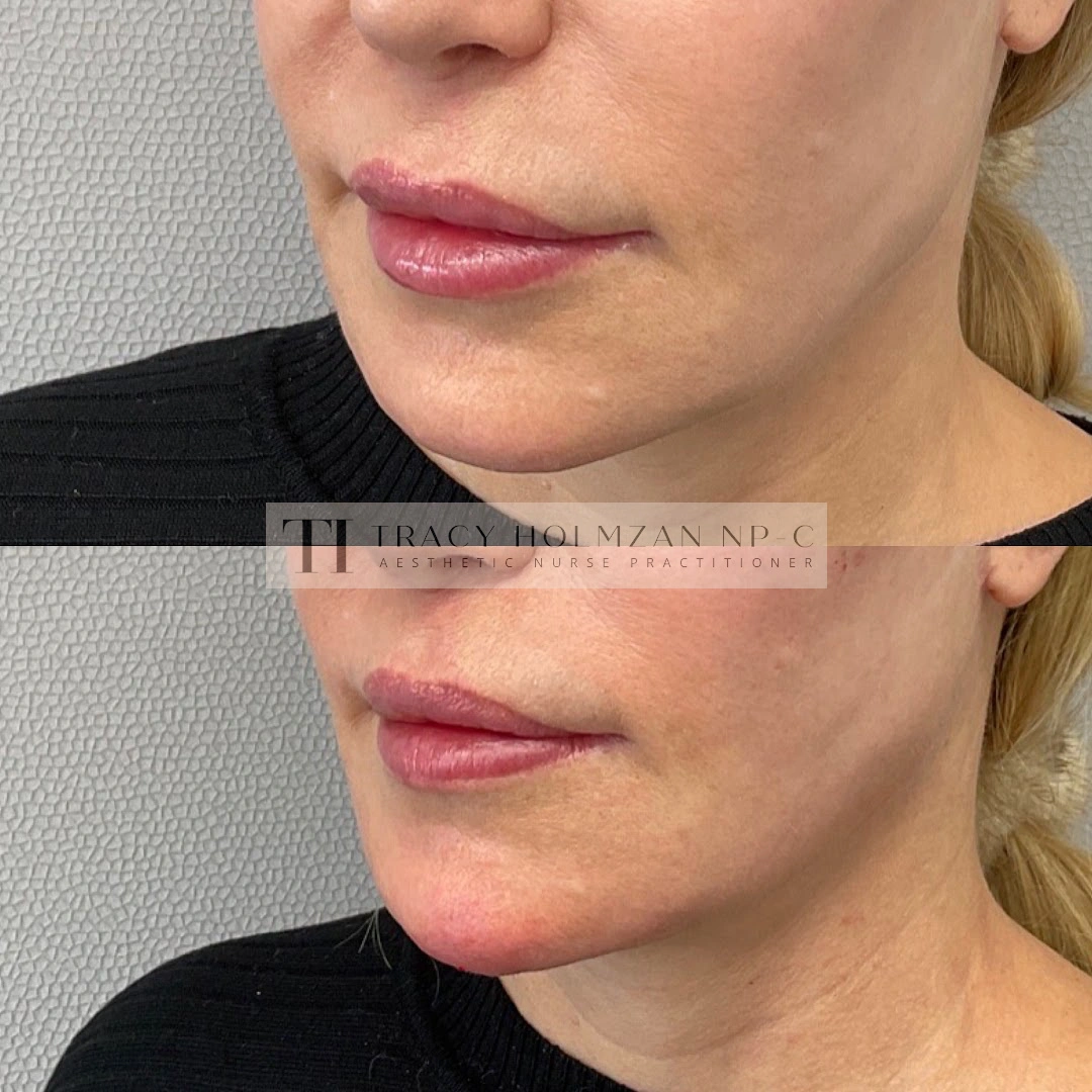 Ritual's Chin Filler Treatment Before & After Result