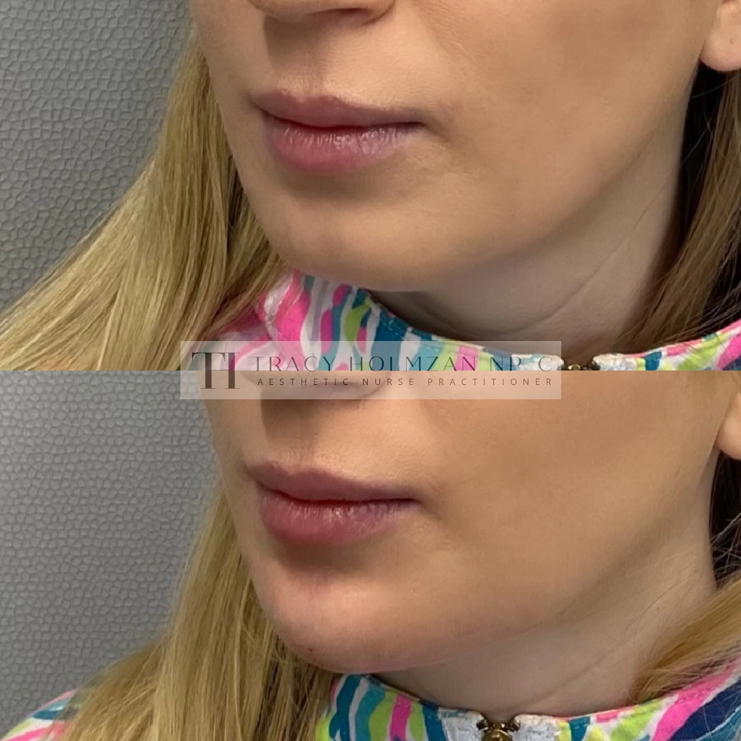 Ritual's Chin Filler Treatment Before & After Result