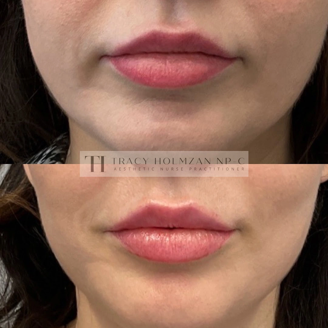 Lip Filler Treatment Before & After Result | Ritual in Washington, DC