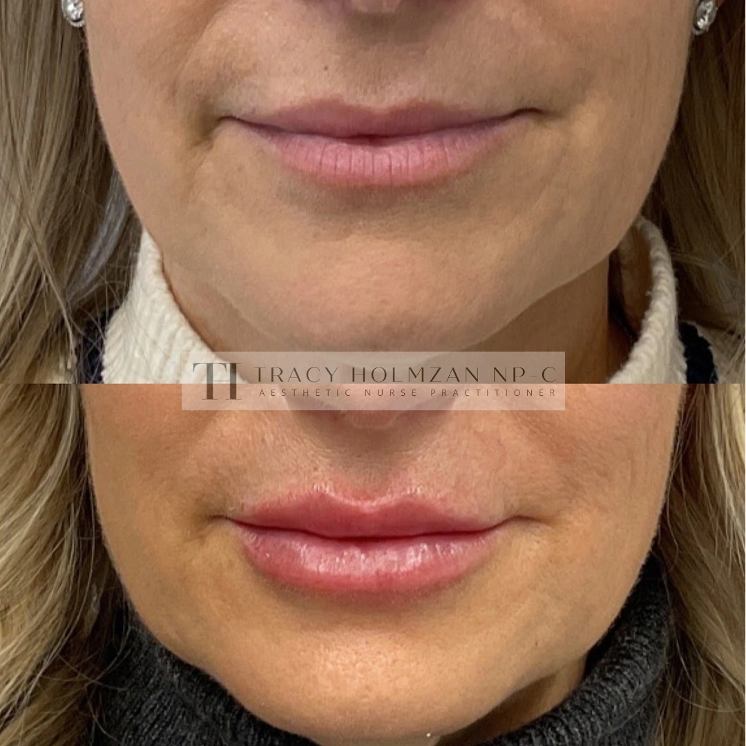 Lip Filler Treatment Before & After Result | Ritual in Washington, DC