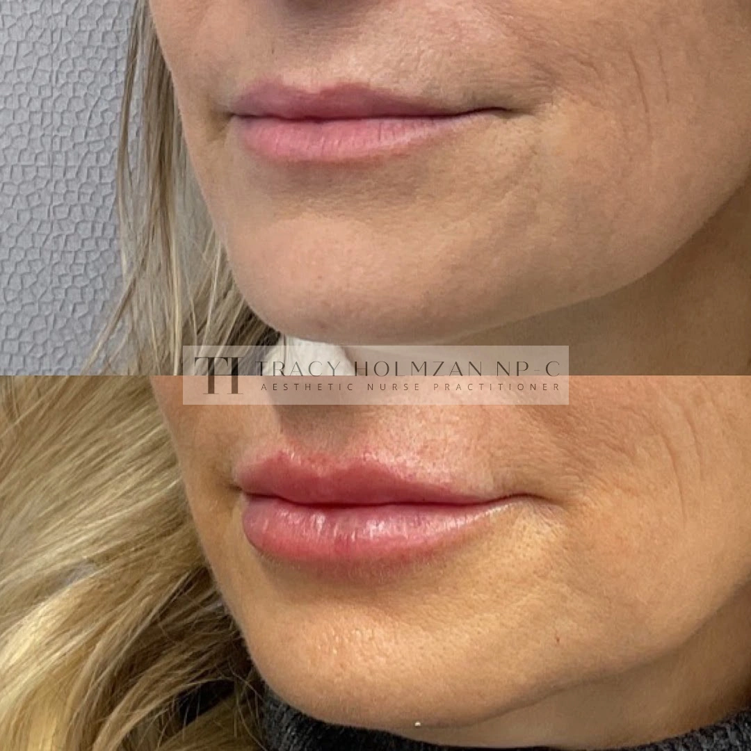 Lip Filler Treatment Before & After Result | Ritual in Washington, DC