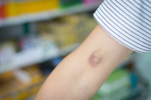 Preventing Bruising And Swelling Post-treatment in Washington, DC