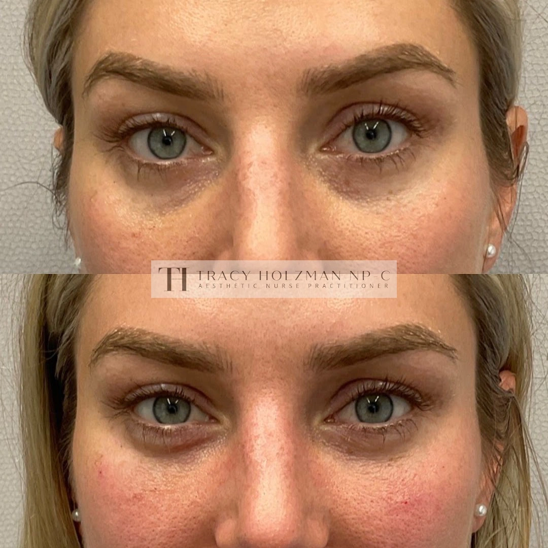 Under Eye Treatment Before & After Result | Ritual in Washington, DC