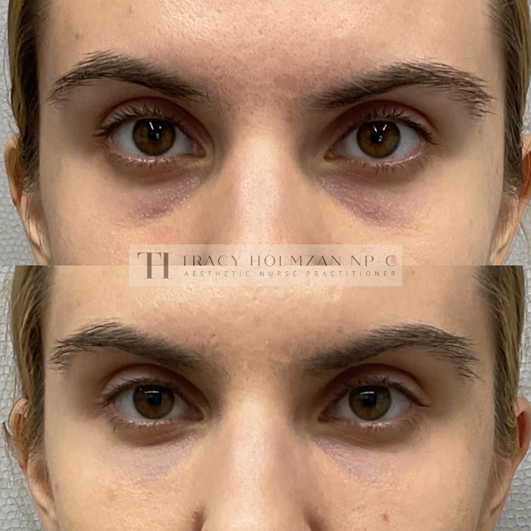 Under Eye Treatment Before & After Result in Ritual