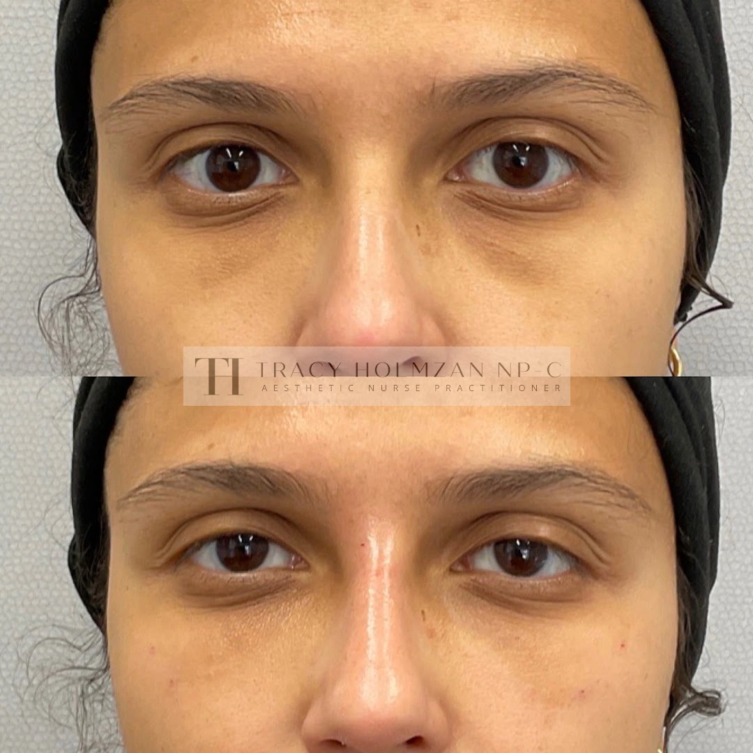 Under Eye Treatment Before & After Result in Ritual