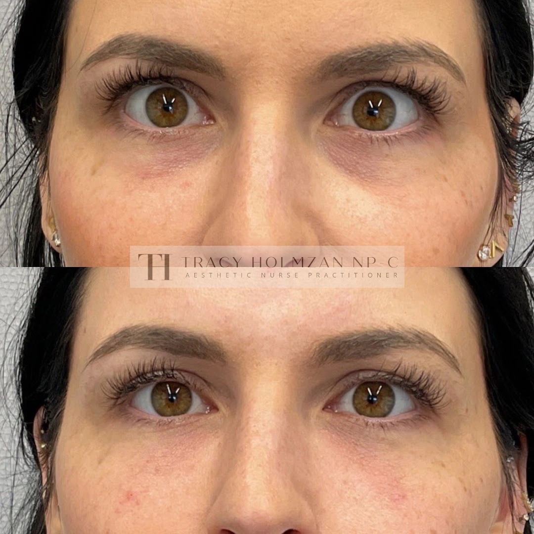 Under Eye Treatment Before & After Result in Ritual