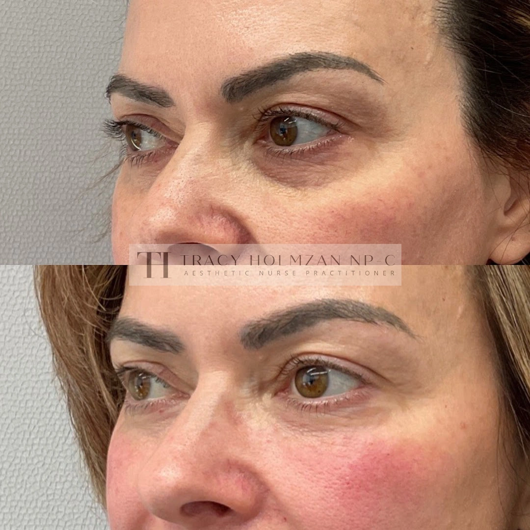 Under Eye Treatment Before & After Result in Ritual