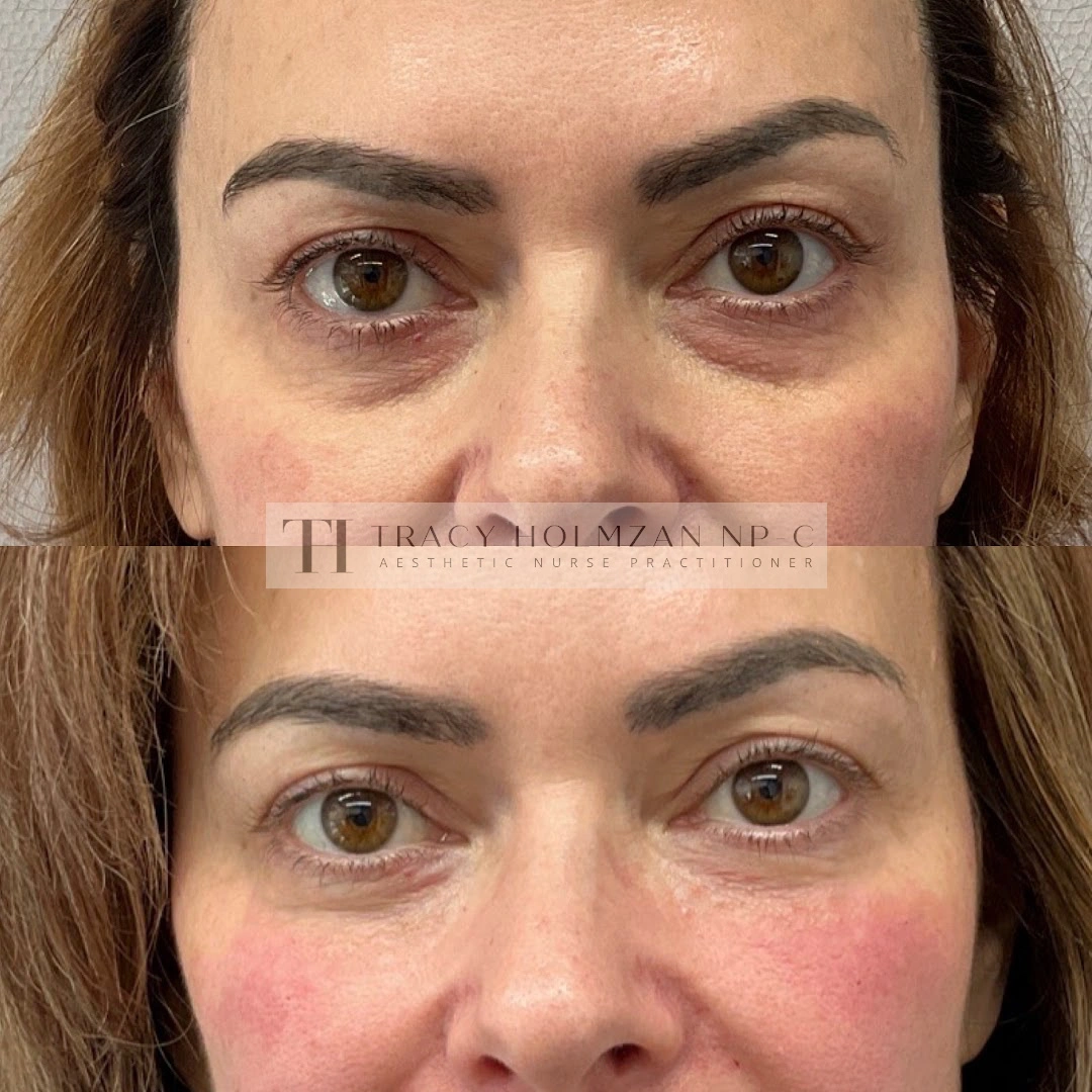 Under Eye Treatment Before & After Result in Ritual