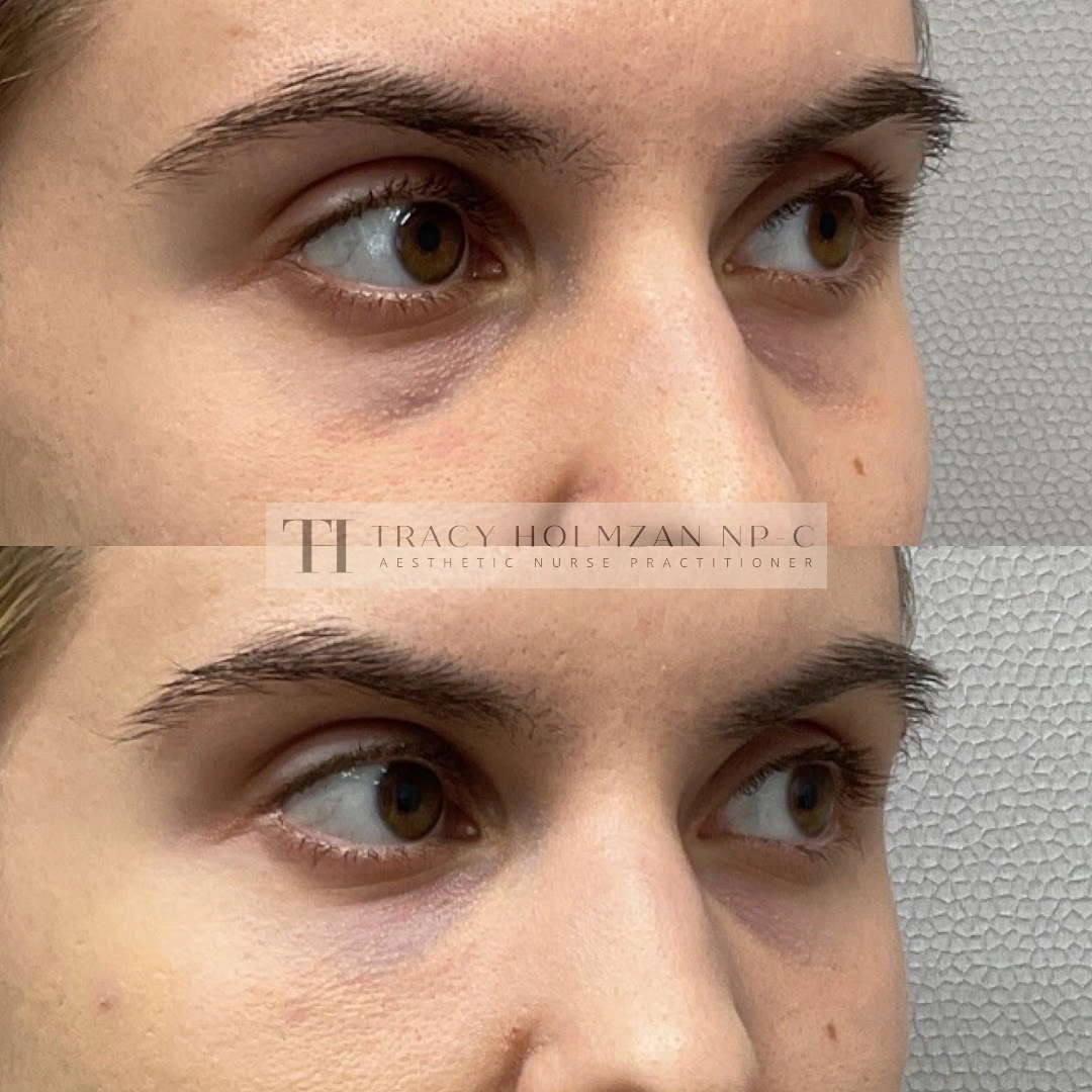 Under Eye Treatment Before & After Result in Ritual