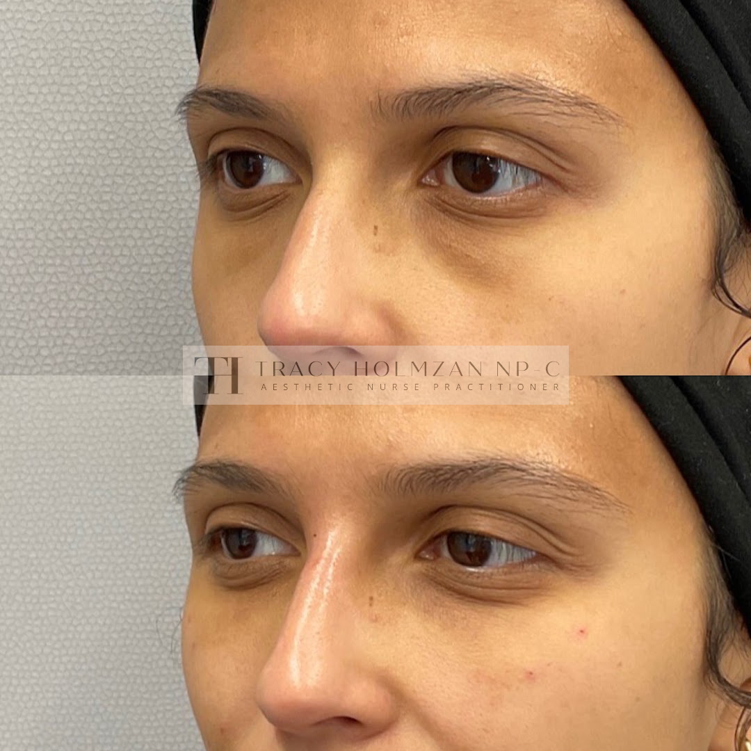 Under Eye Treatment Before & After Result in Ritual