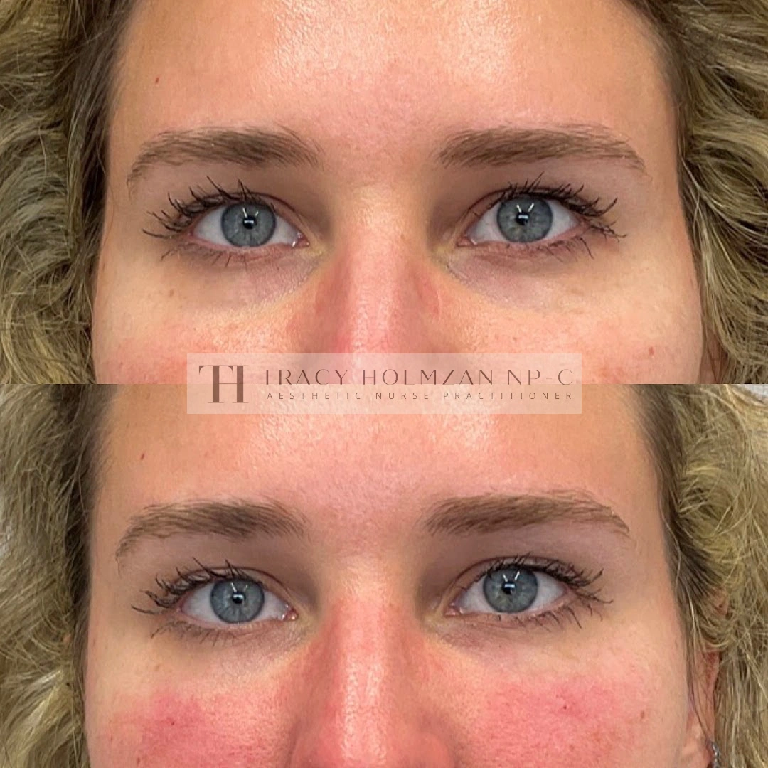 Under Eye Treatment Before & After Result in Ritual