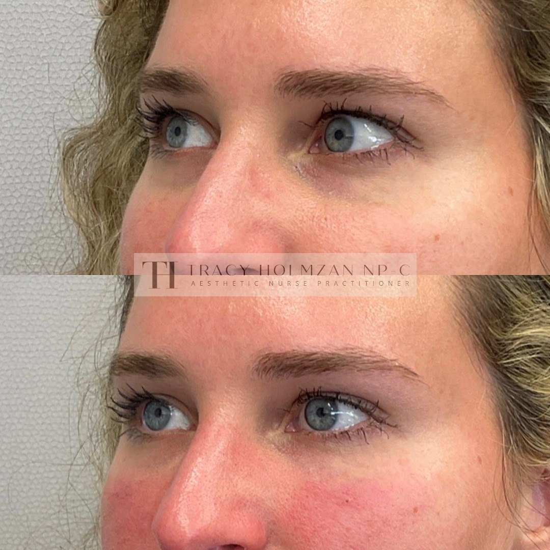 Under Eye Treatment Before & After Result in Ritual