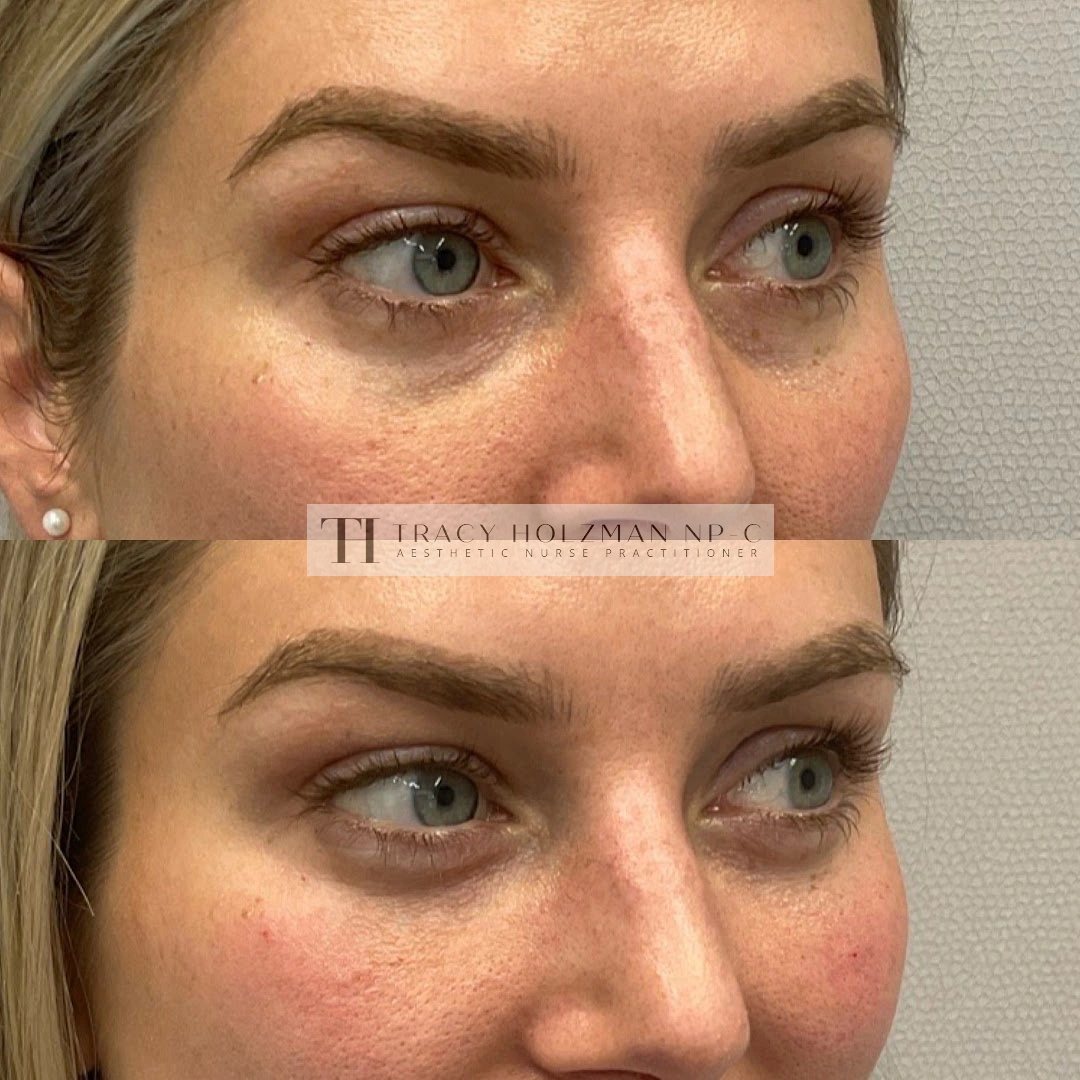 Under Eye Treatment Before & After Result | Ritual in Washington, DC