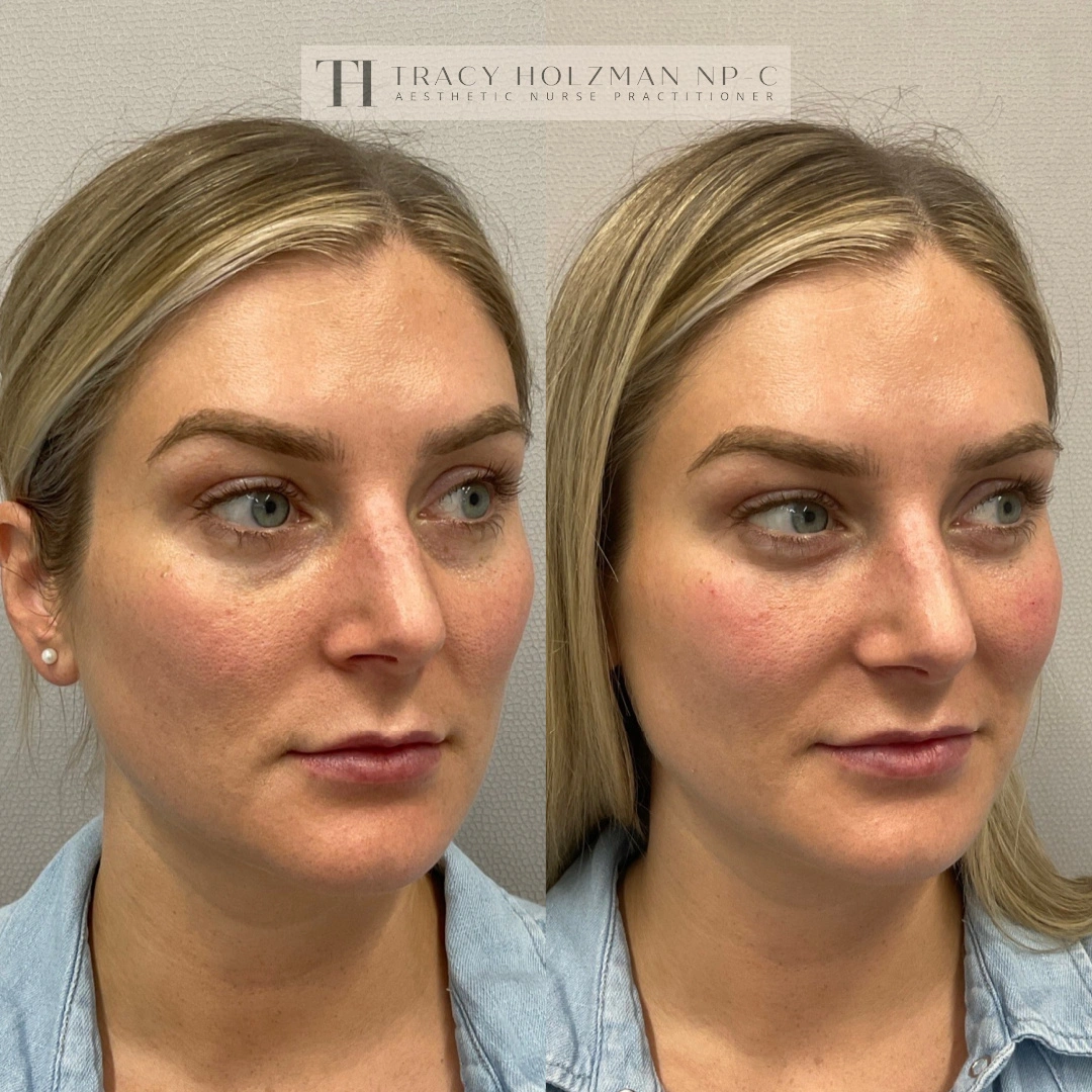 Under Eye Treatment Before & After Result in Ritual