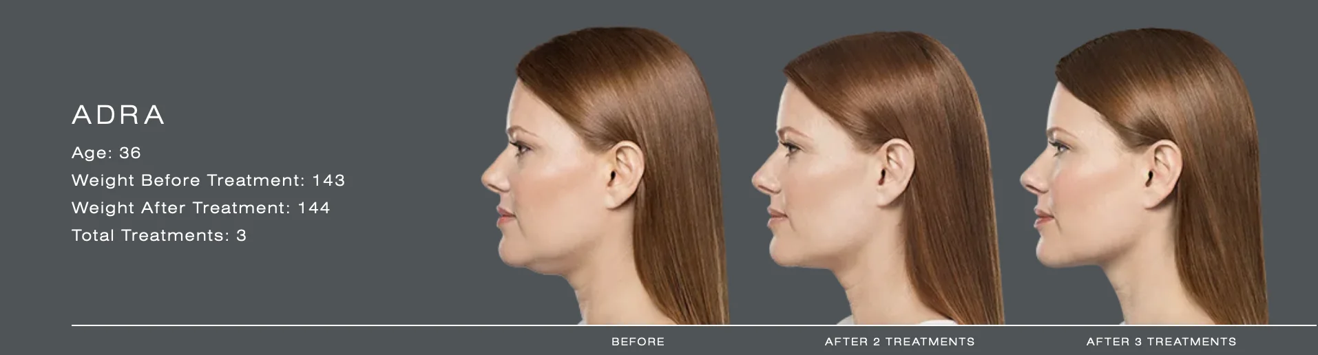 A Woman is receiving Kybella Treatment at Ritual by Tracy Holzman NP-C in Washington, DC