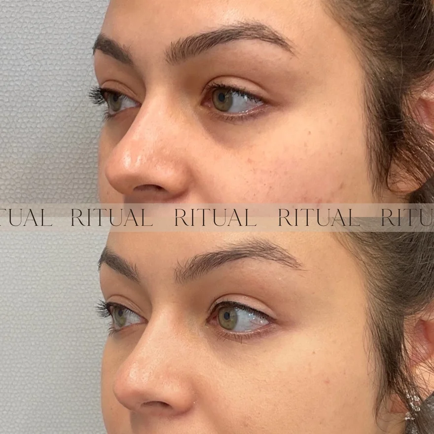 Undereye treatment before and after result | Ritual by Tracy Holzman NP-C in Washington, DC