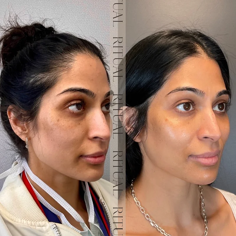 Woman is receiving Sculptra Treatment at Ritual by Tracy Holzman NP-C in Washington, DC