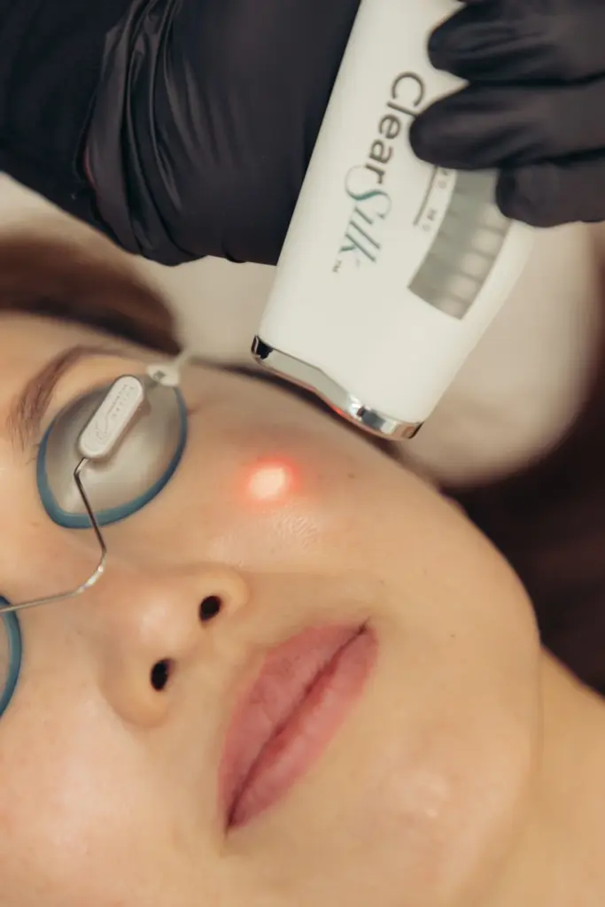 A Woman is Receiving ClearSilk Laser Treatment at Ritual by Tracy Holzman NP-C in Washington, DC