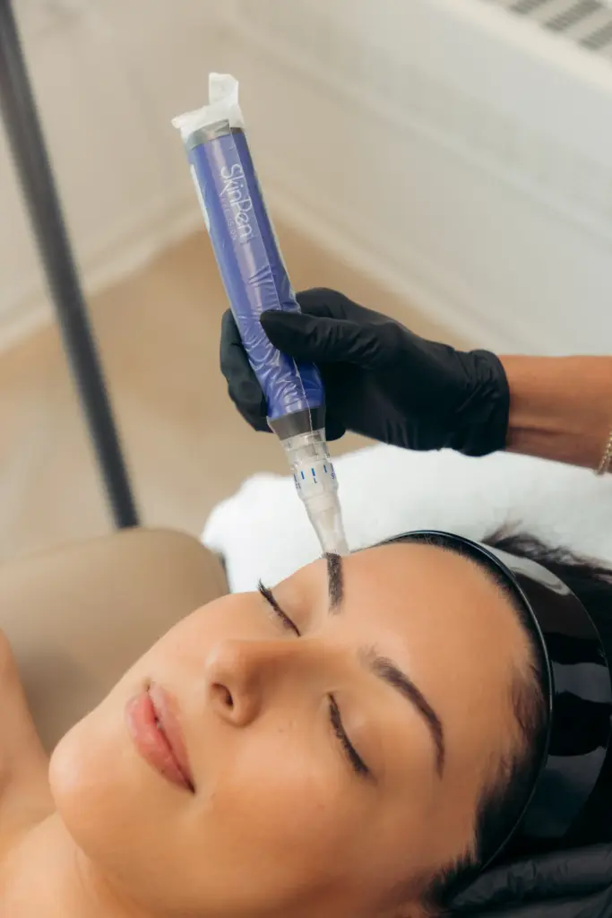 A Woman is receiving SkinPen Microneedling Treatment at Ritual by Tracy Holzman NP-C in Washington, DC