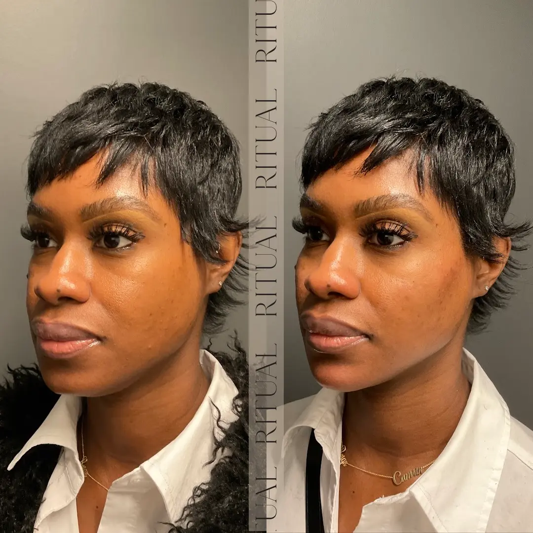Full Face Balancing with Filler Before and After Result | Ritual by Tracy Holzman NP-C in Washington, DC